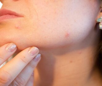 Come si manifesta la dermatite da stress?